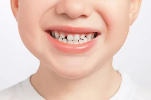 How to Naturally Prevent Teeth Gaps in Children