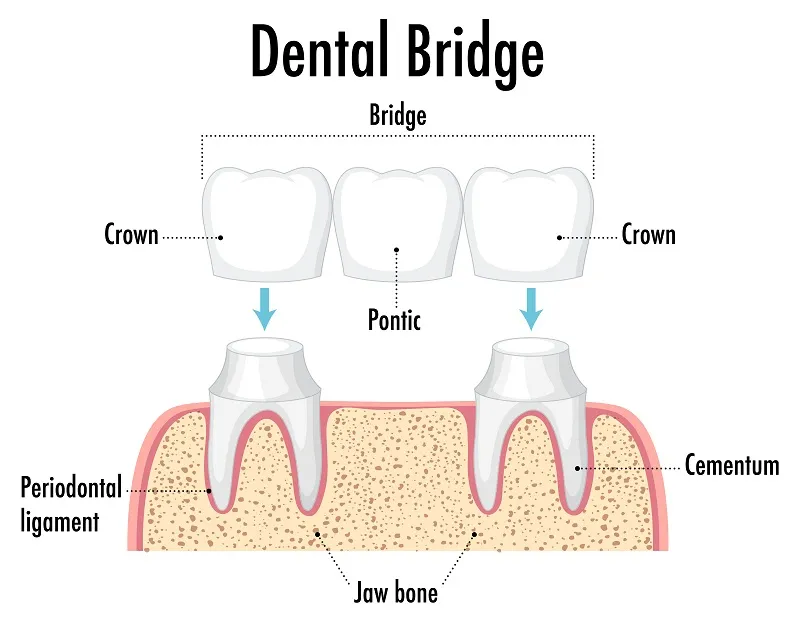 Replace Missing Teeth with Dental Bridges