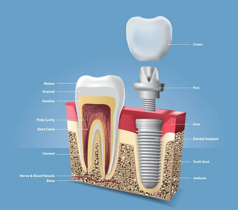 Replace Missing Teeth with Dental Implants