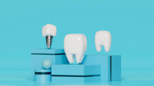 Understanding Types of Dental Implant Materials and Their Uses